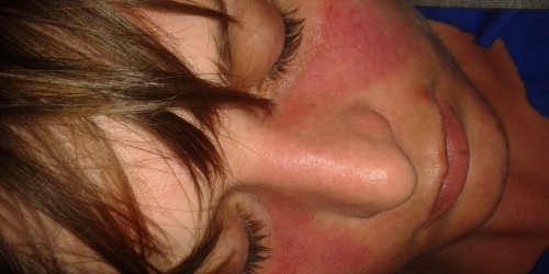 How To Cope With Lupus