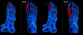 Reflex Sympathetic Dystrophy