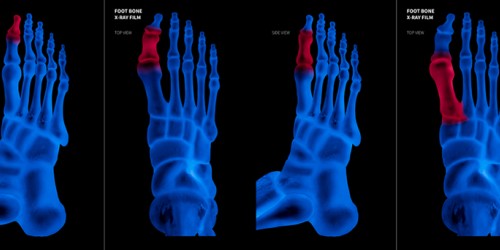 Reflex Sympathetic Dystrophy