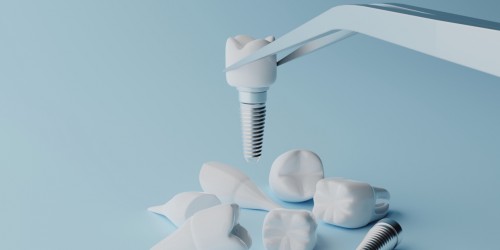 Что такое скуловые имплантаты и подходят ли они всем?