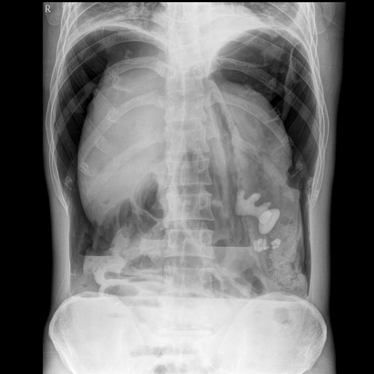 Pain In Lower Left Side Of Abdomen Female Nhs