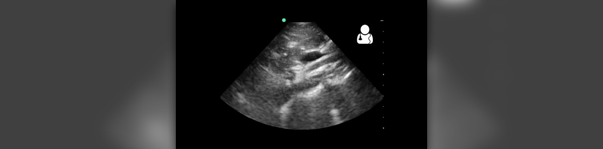 emergency-medicine-blog-a-case-of-recurrent-abdominal-distension