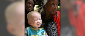 About albinism symptoms