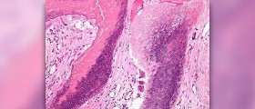 About benign pilomatrixoma
