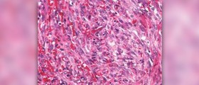 About benign sarcoma