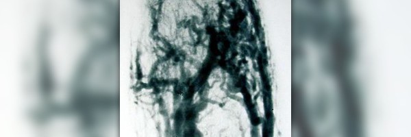 About blocked arteries in neck