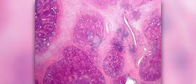 About chronic halitosis
