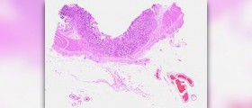About colostomy care
