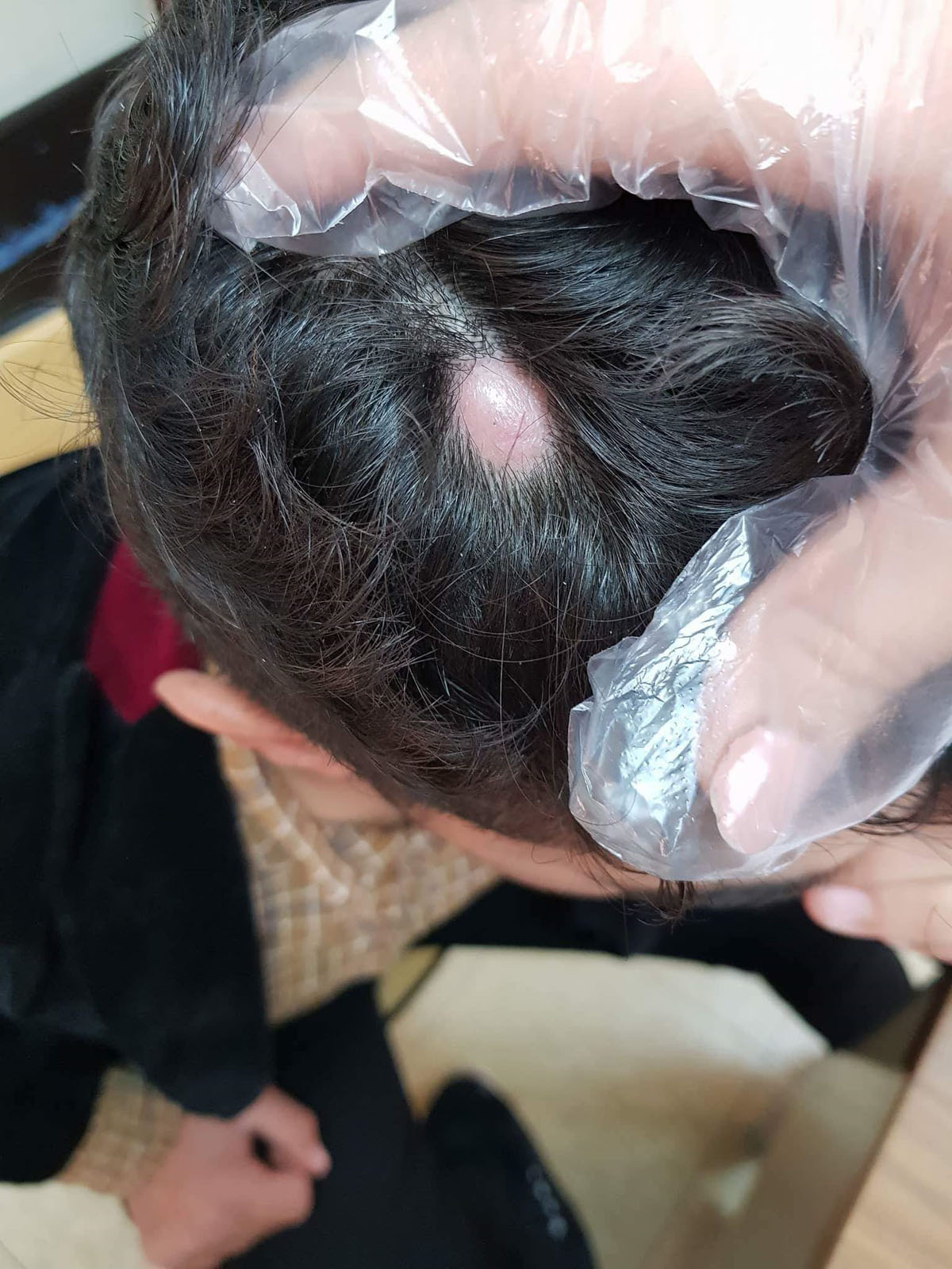 About cyst on scalp | General center | SteadyHealth.com