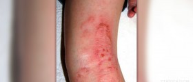 About eczema lotions