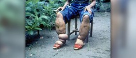 About Elephantiasis treatment
