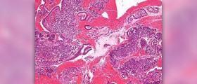 About endometrial conditions