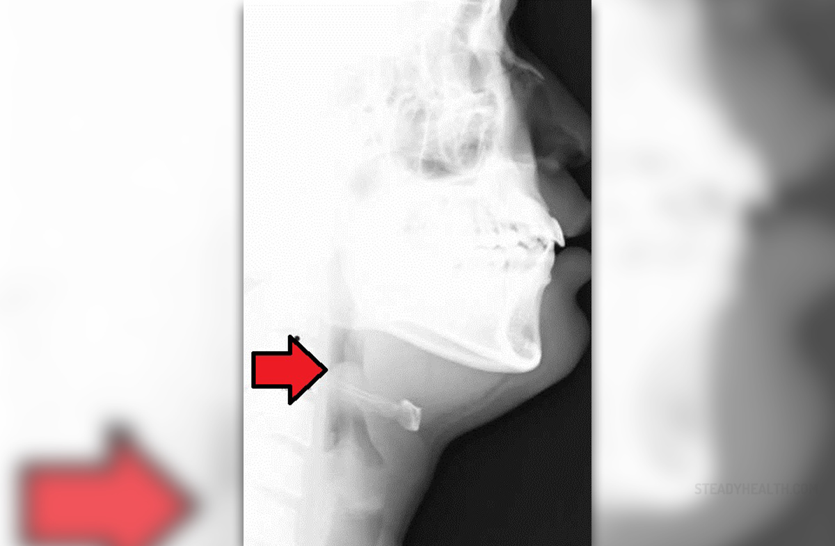 About epiglottis problems | General center | SteadyHealth.com