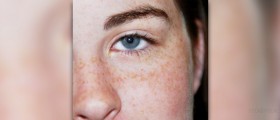 About eye freckle