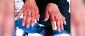 About Frostbite symptoms