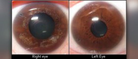 About glaucoma symptoms
