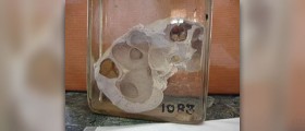 About hydronephrosis facts