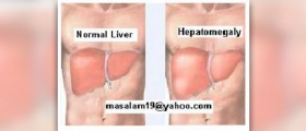 About liver enlargement