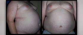 About obesity treatment