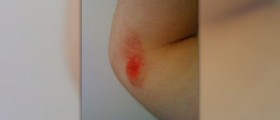 About roseola rash