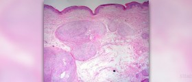 About Schwannoma symptoms