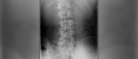About scoliosis pain