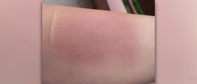 About septal hematoma