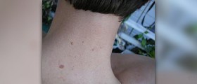 About skin exfoliation
