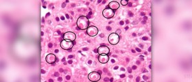 About spironolactone uses
