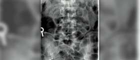 About tailbone injury