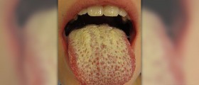About thrush symptoms