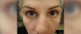 About uneven pupils