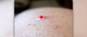 Acne bacteria: the myth and the facts