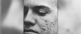 Acne scarring home treatments that work