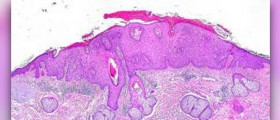 Actinic keratosis facts