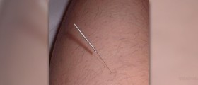 Acupuncture effective against headaches