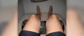 Acupuncture for anxiety