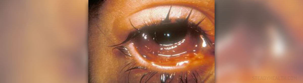 acute-bacterial-conjunctivitis-general-center-steadyhealth