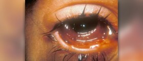 Acute bacterial conjunctivitis