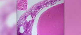 Acute bacterial meningitis