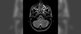 Acute bacterial sinusitis