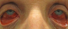 Acute headache facts