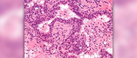 Acute hypercalcemia facts