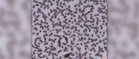 Acute liver disease