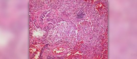 Acute lower respiratory infection