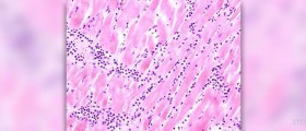 Acute multifocal placoid pigment epitheliopathy