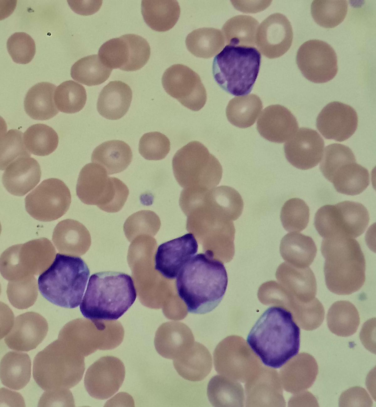 acute-myeloid-leukemia-risk-factors-acute-myeloid-leukemia-aml-is-a