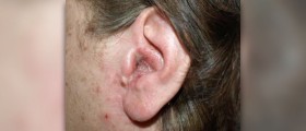 Acute otitis externa