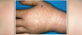 Acute paronychia facts