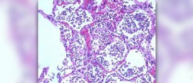Acute pneumonia facts